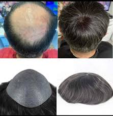 Advance Hair Transplant Clinic