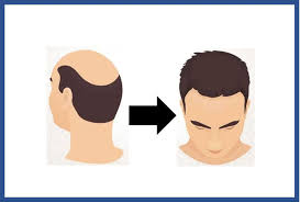 Advance Hair Transplant Clinic